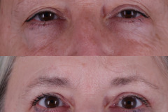 Upper & Lower Eyelid Surgery