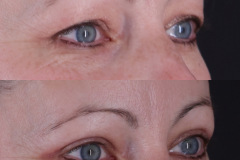 Upper Eyelid Surgery