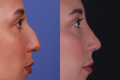 Rhinoplasty