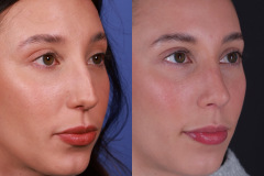 Rhinoplasty