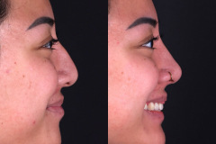 Rhinoplasty