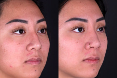 Rhinoplasty