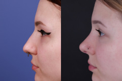 Rhinoplasty